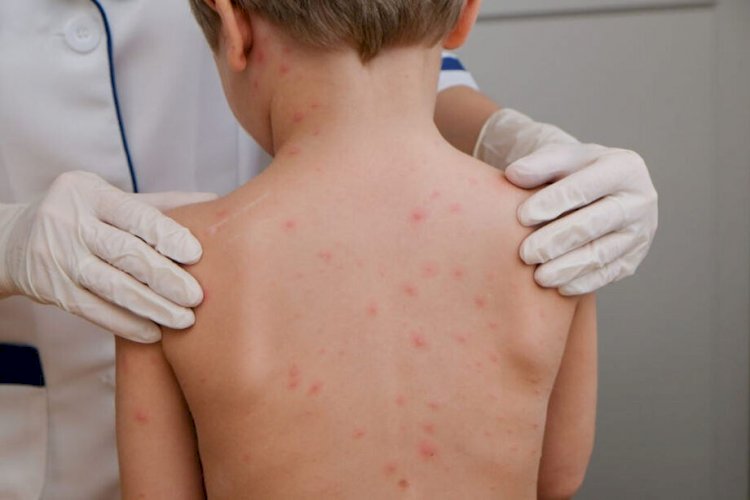 Casos de meningite acendem alerta para cuidados, mas Governo de MT descarta surto